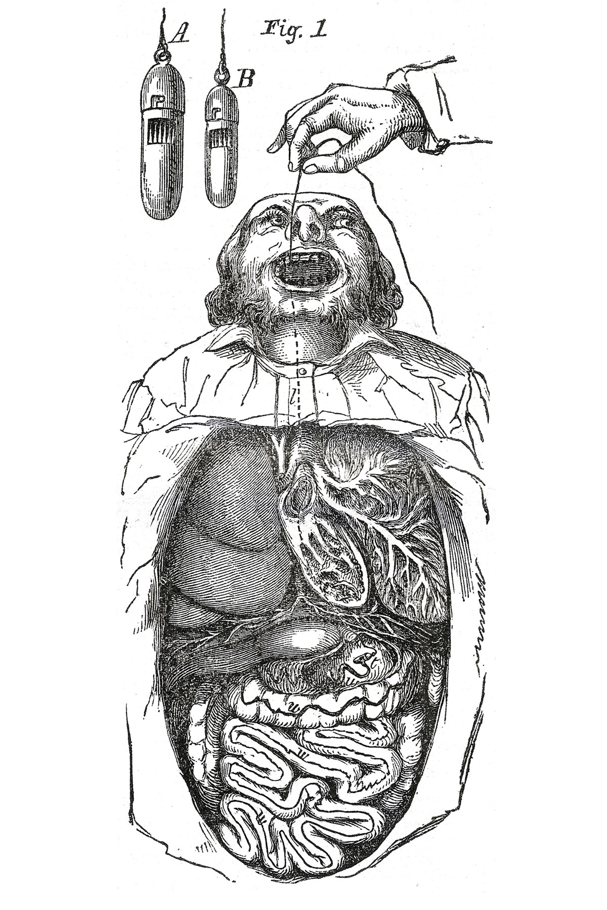 A drawing of the Myers tapeworm trap. 