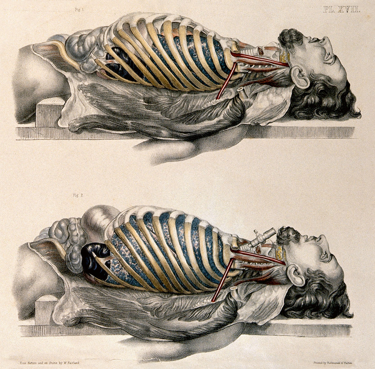An 1869 lithograph by William Fairland documenting the work of anatomist Francis Sibson. The two figures show the lungs after breathing out and after breathing in. 