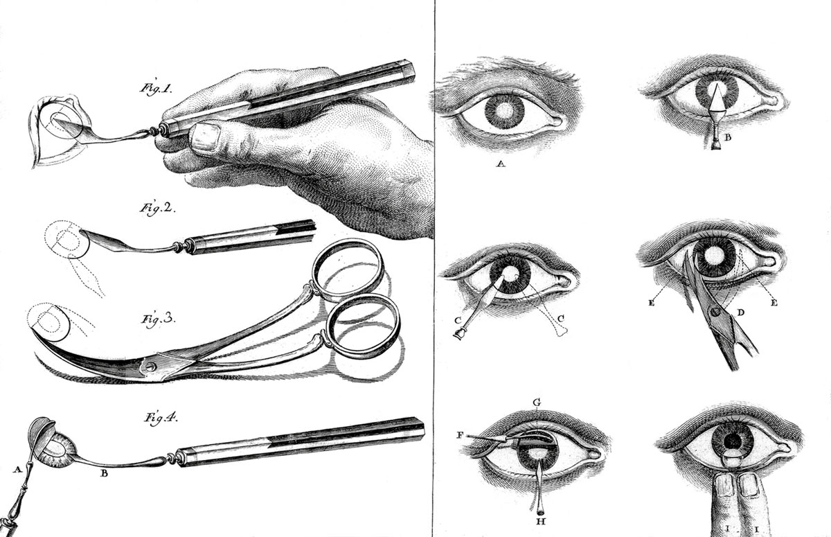 Instruments used in cataract operations. From a 1780 edition of Johannes de Gorter’s Cirugia expurgada. Courtesy Wellcome Library.