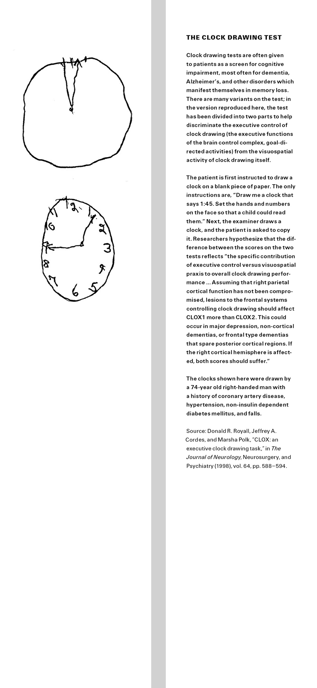 The front and back of this issue’s bookmark. The front shows two clocks drawn in a shaky hand. The back reads: “The Clock Drawing Test. Clock drawing tests are often given to patients as a screen for cognitive impairment, most often for dementia, Alzheimer’s, and other disorders which manifest themselves in memory loss. There are many variants on the test; in the version reproduced here, the test has been divided into two parts to help discriminate the executive control of clock drawing (the executive functions of the brain control complex, goal-directed activities) from the visuospatial activity of clock drawing itself. The patient is first instructed to draw a clock on a blank piece of paper. The only instructions are, “Draw me a clock that says 1:45. Set the hands and numbers on the face so that a child could read them.” Next, the examiner draws a clock, and the patient is asked to copy it. Researchers hypothesize that the difference between the scores on the two tests reflects “the specific contribution of executive control versus visuospatial praxis to overall clock drawing performance … Assuming that right parietal cortical function has not been compromised, lesions to the frontal systems controlling clock drawing should affect CLOX1 more than CLOX2. This could occur in major depression, non-cortical dementias, or frontal type dementias that spare posterior cortical regions. If the right cortical hemisphere is affected, both scores should suffer.” The clocks shown here were drawn by a 74-year old right-handed man with a history of coronary artery disease, hypertension, non-insulin dependent diabetes mellitus, and falls. Source: Donald R. Royall, Jeffrey A. Cordes, and Marsha Polk, “CLOX: an executive clock drawing task,” in The Journal of Neurology, Neurosurgery, and Psychiatry (1998), vol. 64, pp. 588–594.”