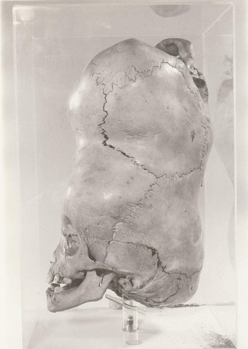 A photograph of the skull of the two-headed boy from Bengal.