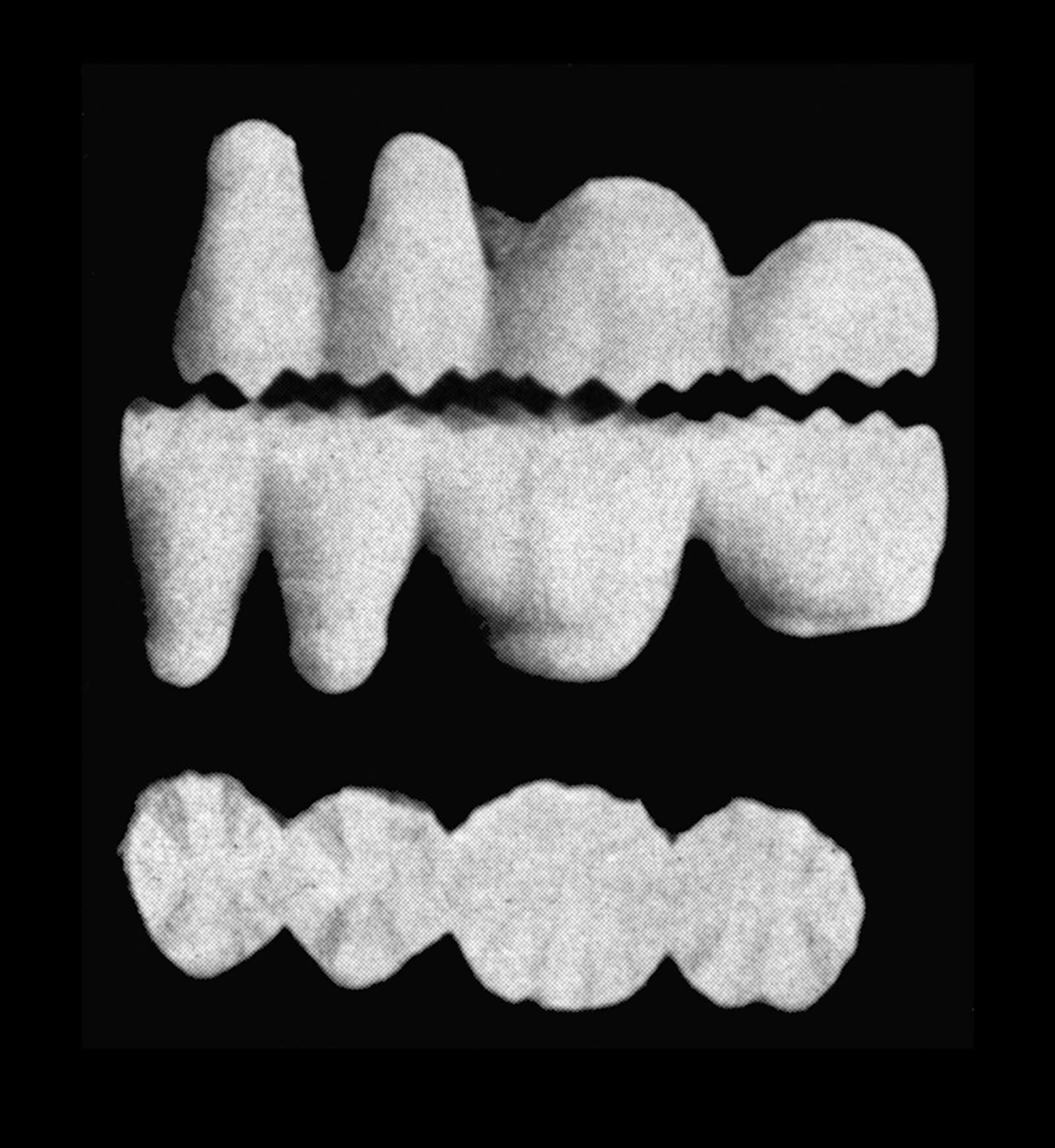 An image of posterior tooth blocks, designed by LeRoy E. Kurth in nineteen forty-five for improved shredding.